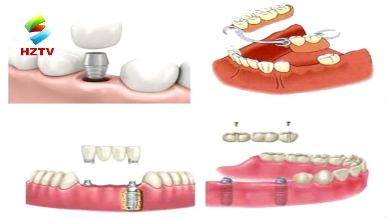 口腔假牙护理,假牙要如何护理不伤害口腔