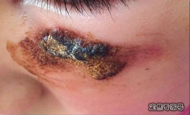 抹芦荟胶有多大的伤害,芦荟胶不是万能的小心毁了你的脸