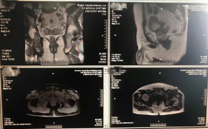 前列腺癌骨转移免疫疗法效果好吗,局限性前列腺癌治疗策略
