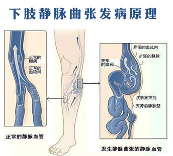 筋疙瘩怎么去除,筋疙瘩好治吗