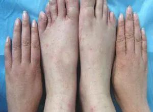 手指上有小水泡是脚气吗,手指上起小水泡就一定是汗疱疹吗