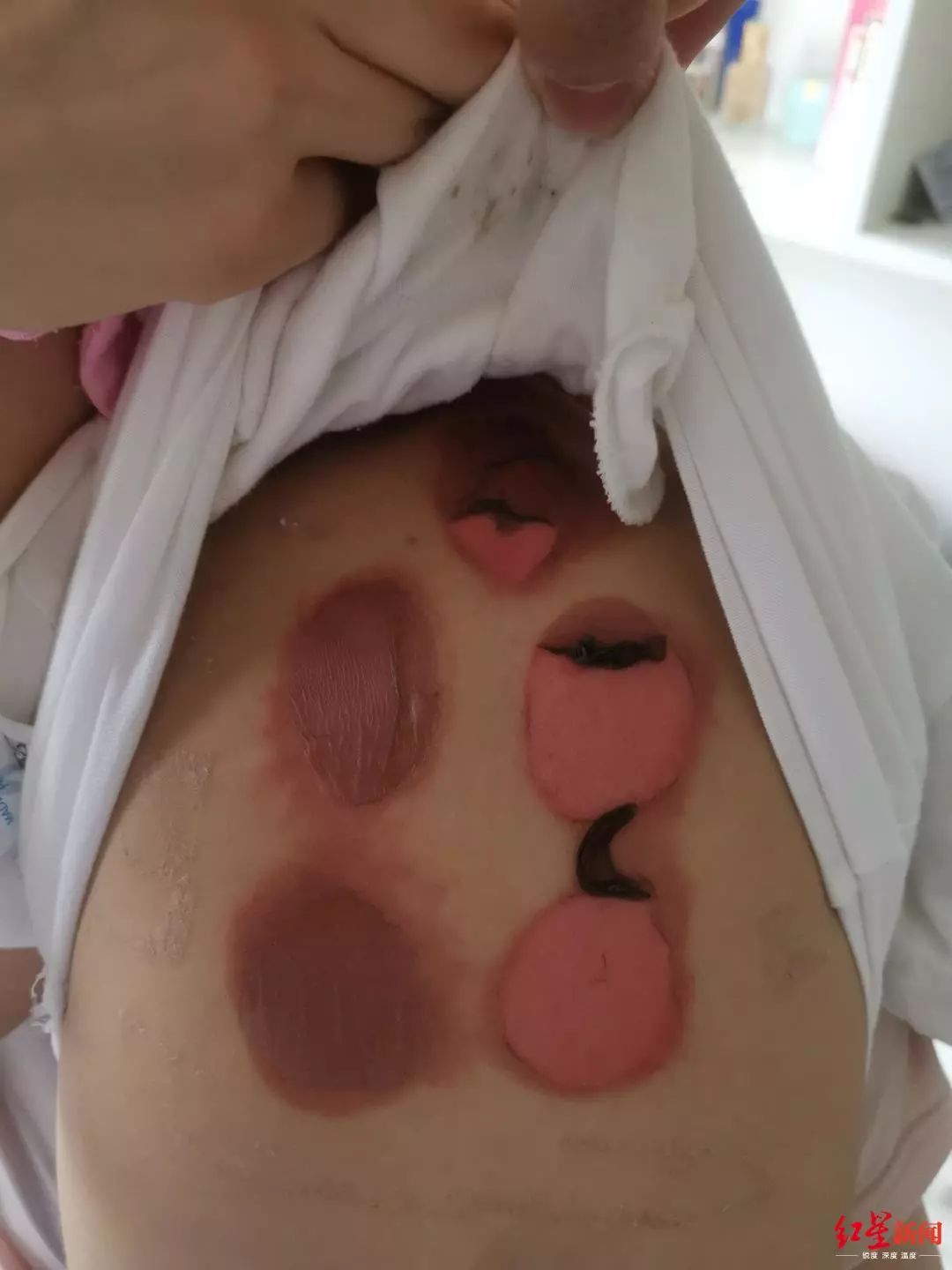 92名儿童被三伏贴灼伤看着心疼,92名儿童贴三伏后被烧伤