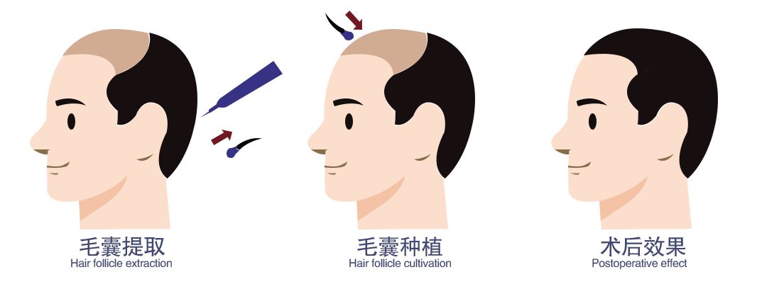 报道来了！28岁小伙“秃”成50岁？过年前抓紧……芜湖全面启动