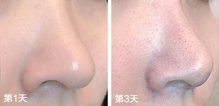 严重的黑头怎么处理教程,反复黑头的原因和解决方法