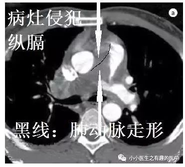 肺动脉分支充盈欠佳是肺栓塞吗,肺动脉缺损不可逆