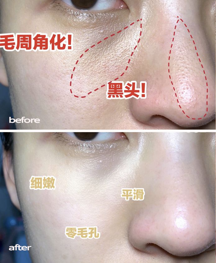 脸上搓出3斤泥！难怪又黄又暗又黑头！10秒给脸蛋“剥壳”，厉害