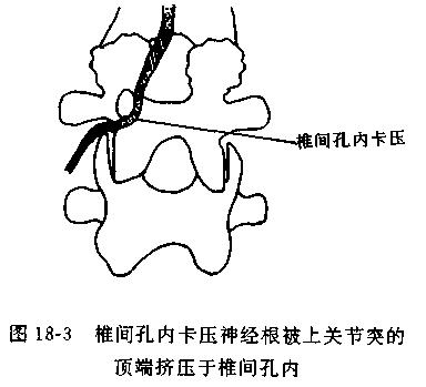 一分钟带你了解腰椎狭窄,椎管狭窄症知识大全