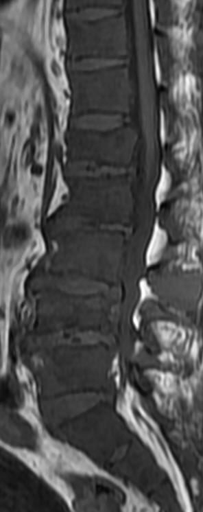 一分钟带你了解腰椎狭窄,椎管狭窄症知识大全