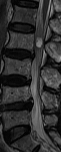 一分钟带你了解腰椎狭窄,椎管狭窄症知识大全