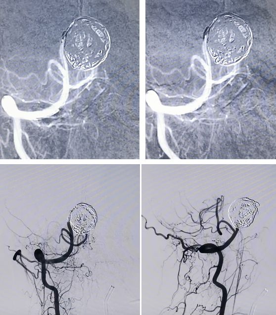 椎动脉夹层动脉瘤的最佳治疗方法,椎基底动脉夹层动脉瘤治疗方法