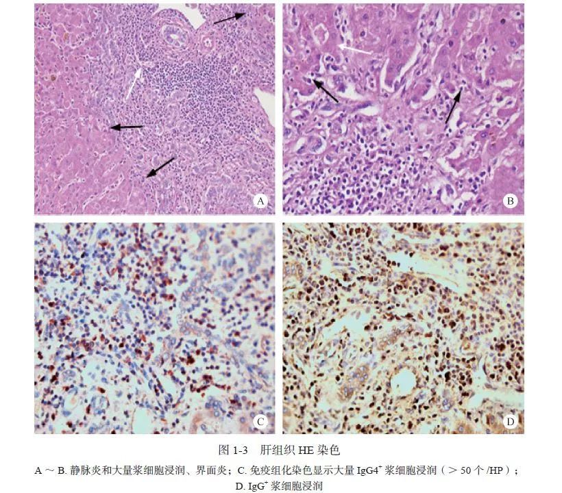 igg4疾病胆管炎会引起ca199升高吗,igg4相关性胆管炎误诊为胆管癌
