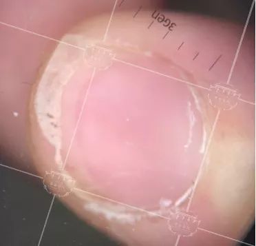 灰指甲美甲处理,灰指甲霉菌感染致癌