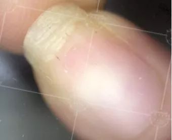 灰指甲致癌吗,灰指甲美甲的禁忌