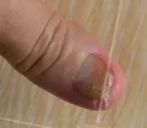 灰指甲致癌吗,灰指甲美甲的禁忌