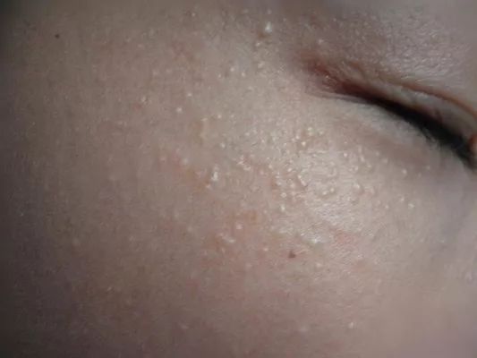 脂肪粒的由来,杏林微科普帮您认识各类头晕