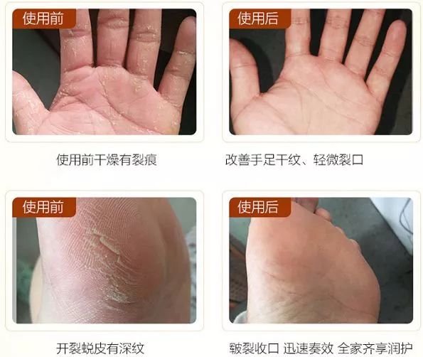 治脚气干裂起皮用什么药膏,有这个方子来治脚气就不怕复发