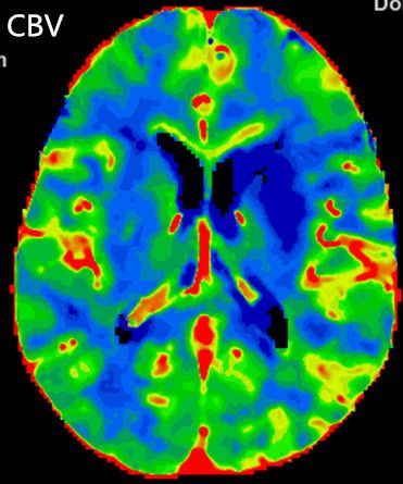 Reco特约·第10期｜国产组合助力取栓“一把通”——Ewata球囊导引导管联合Reco支架取栓分享