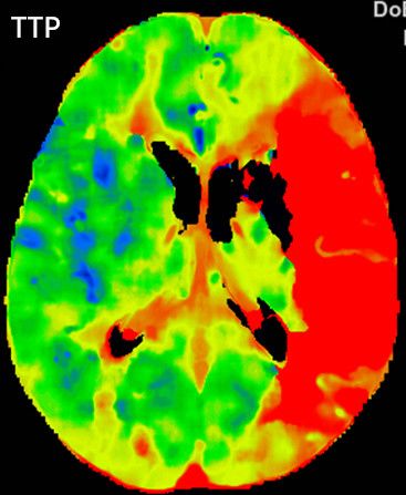Reco特约·第10期｜国产组合助力取栓“一把通”——Ewata球囊导引导管联合Reco支架取栓分享