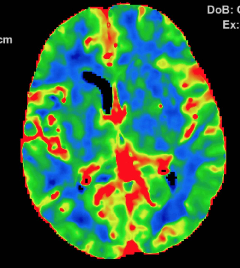 Reco特约·第10期｜国产组合助力取栓“一把通”——Ewata球囊导引导管联合Reco支架取栓分享