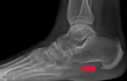足底筋膜炎与足跟骨刺的治疗方法,筋骨堂治疗骨质增生能去掉吗