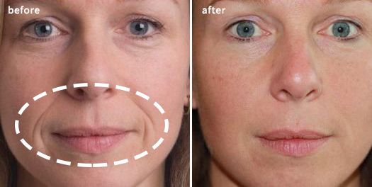 消除眉间法令纹最有效的方法,眉间纹和法令纹医美