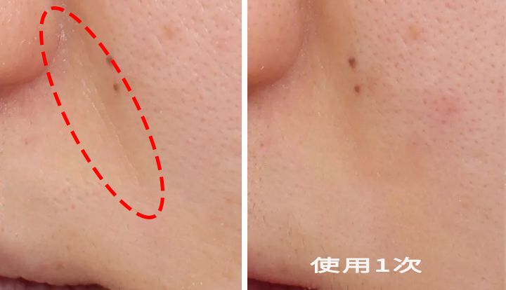 眉间纹和法令纹除皱针能去掉吗,嘴角纹法令纹抬头纹国货推荐