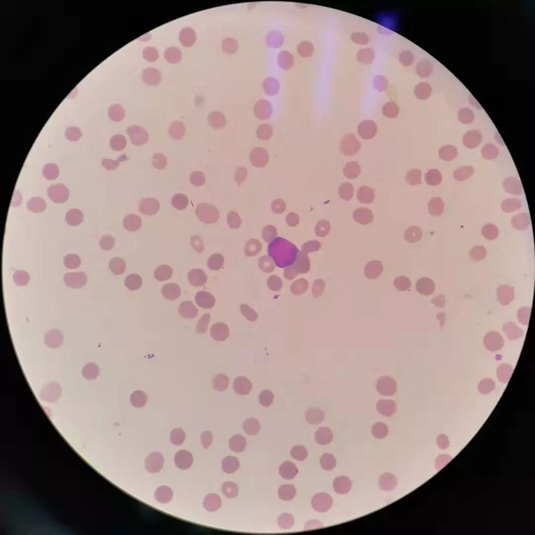 全血细胞减少就是白血病,全血细胞减少性白血病