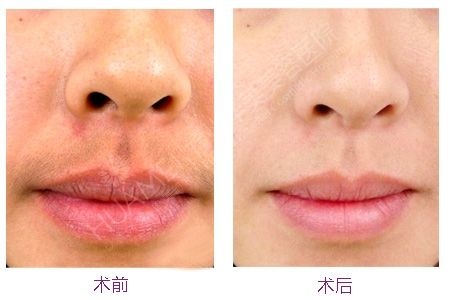 女人竟然长了胡子,女孩子长胡子用脱毛膏