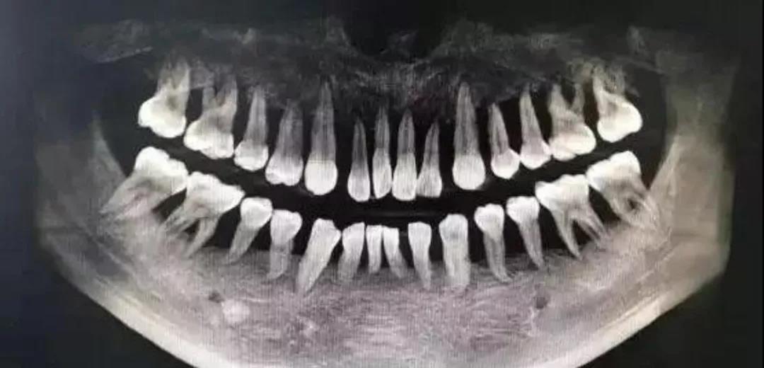 一张“示意图”告诉你，牙不好是怎样连累心血管的…