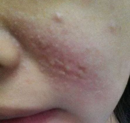 隐形虫叮咬后症状图片,隐翅虫被叮咬后会有什么生命危险