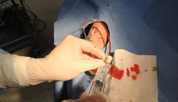 心脏造影和支架一起做大概多少钱,心脏造影支架视频全过程