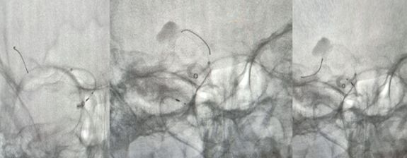 治疗颅内动脉瘤新型密网支架,密网支架处理动脉瘤的风险