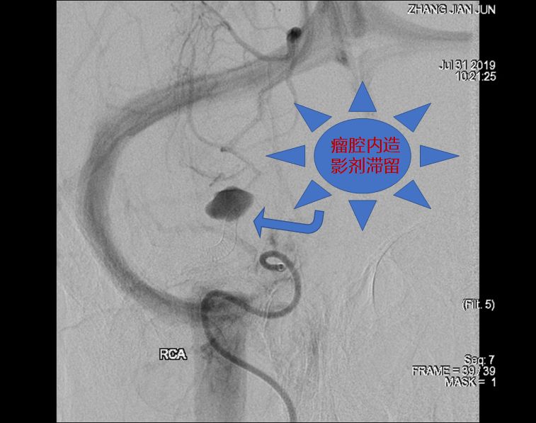 治疗颅内动脉瘤新型密网支架,pipeline治疗椎动脉夹层动脉瘤