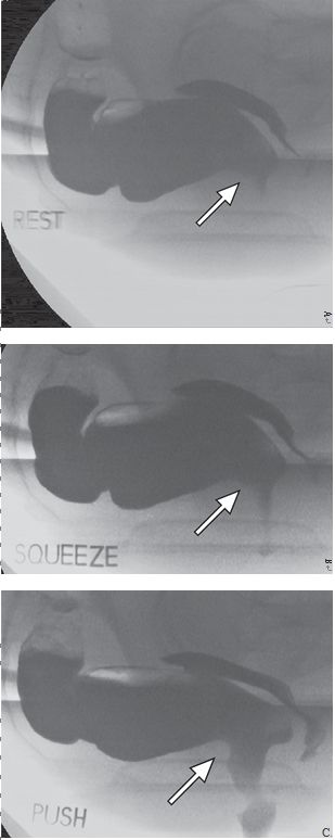 一文读懂:盆底功能障碍的影像学表现|临床实战