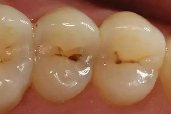 蛀牙禁忌吃什么,蛀牙到底该补还是该治疗