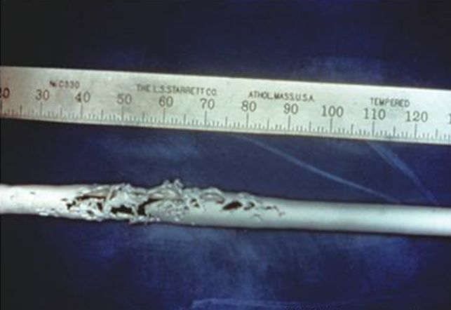 血透动静脉内瘘手术三种术式图解,血透室动静脉内瘘穿刺及护理