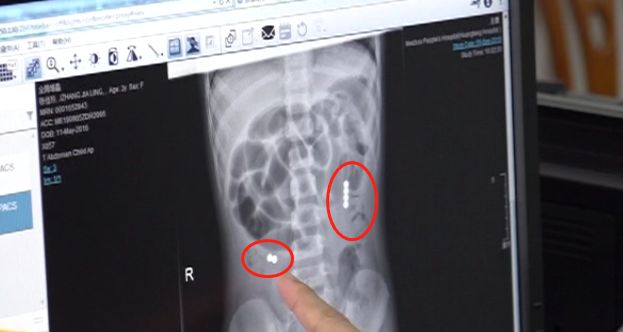 3岁女童患怪病肚子大如球,7岁女童突然腹痛元凶竟是畸胎瘤