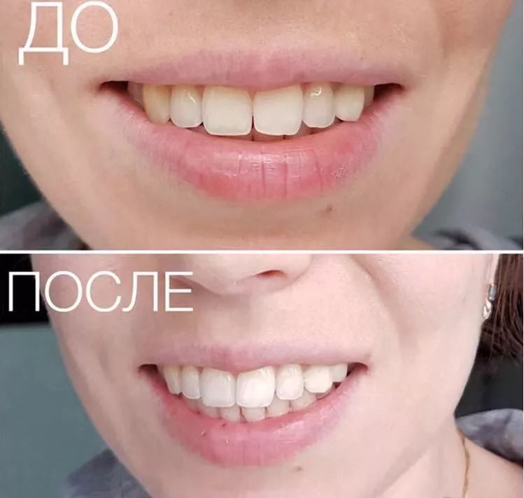 俄罗斯牙膏去黄牙怎么样,祛牙垢黄牙的牙膏国货之光