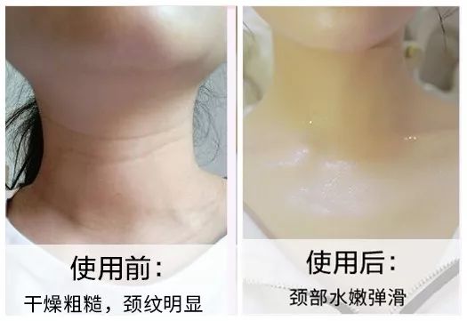 蛋白贴去皱,胶原蛋白颈纹贴