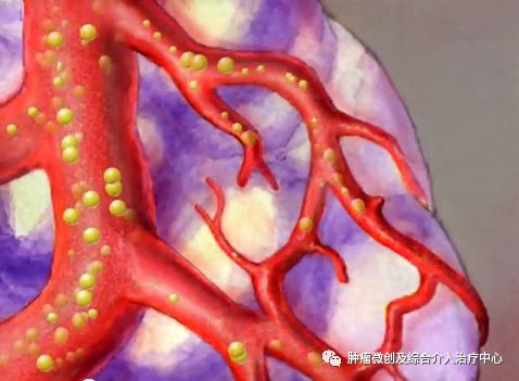 运城市第一医院介入科特色技术——肿瘤的化疗栓塞术