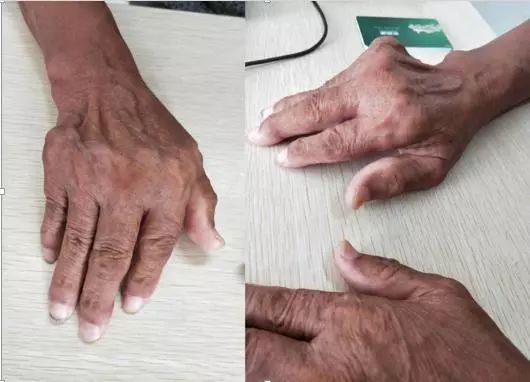 Whipple病、纹状体手、神经结节病、脱髓鞘假瘤丨3分钟读片·第16期