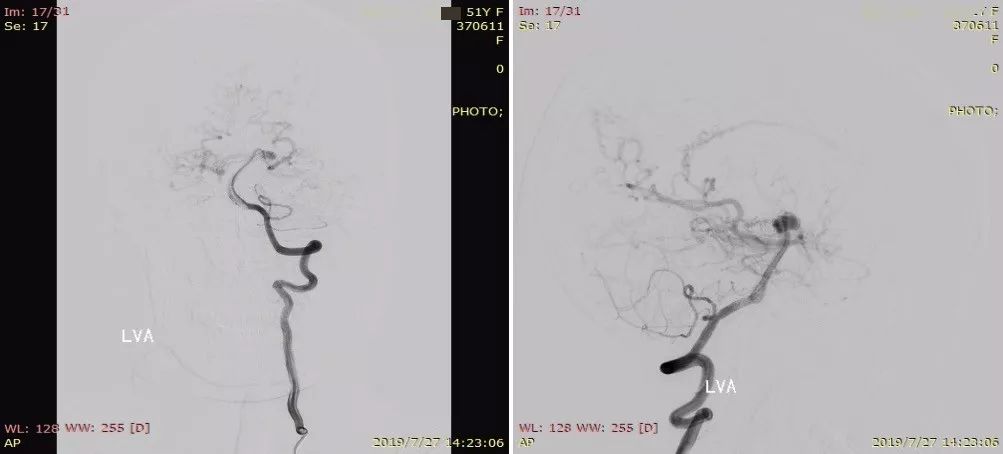 物华天宝·第12期｜复发多发动脉瘤合并烟雾病的支架辅助弹簧圈栓塞治疗
