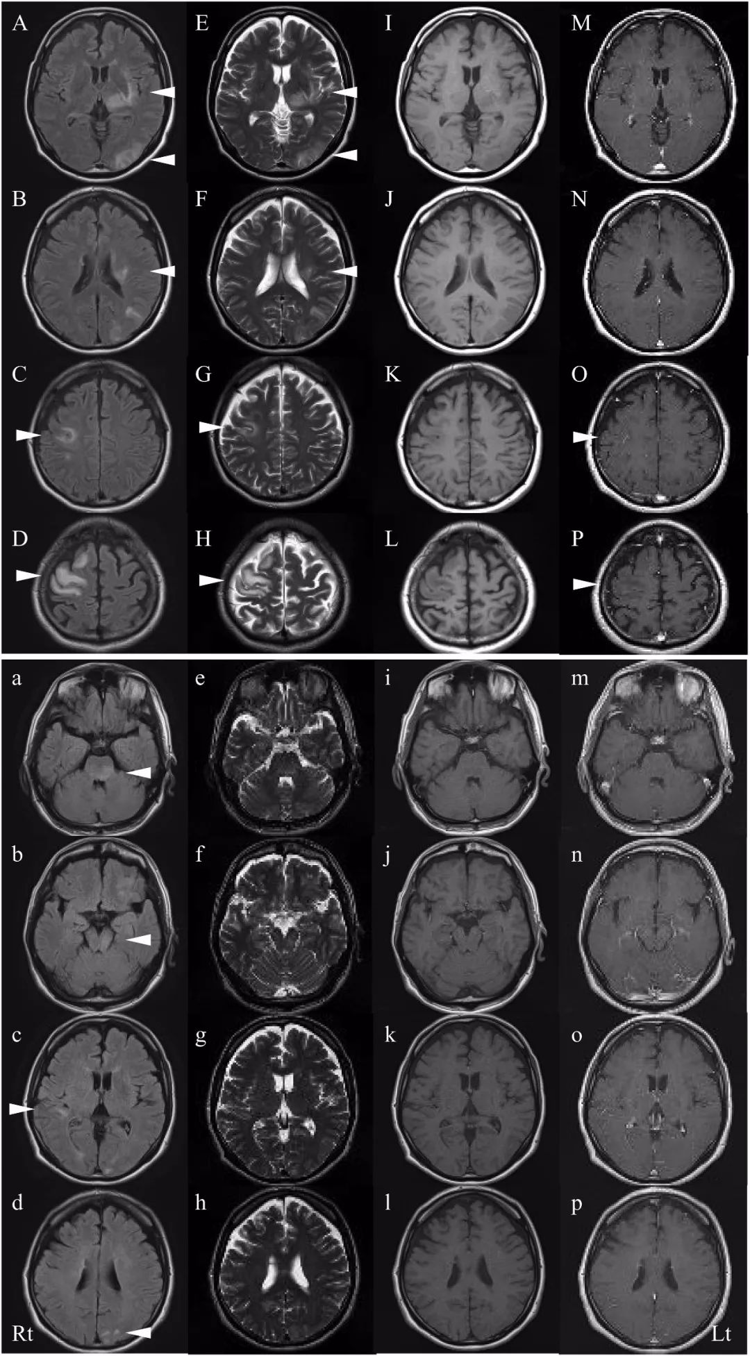 mog抗体阳性脑炎能活多久,mog抗体相关性脑炎治愈