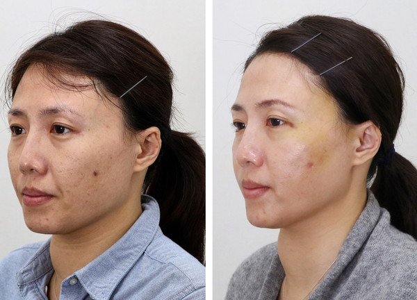 脸下垂提拉紧致图片,提拉下颚线打造小v脸