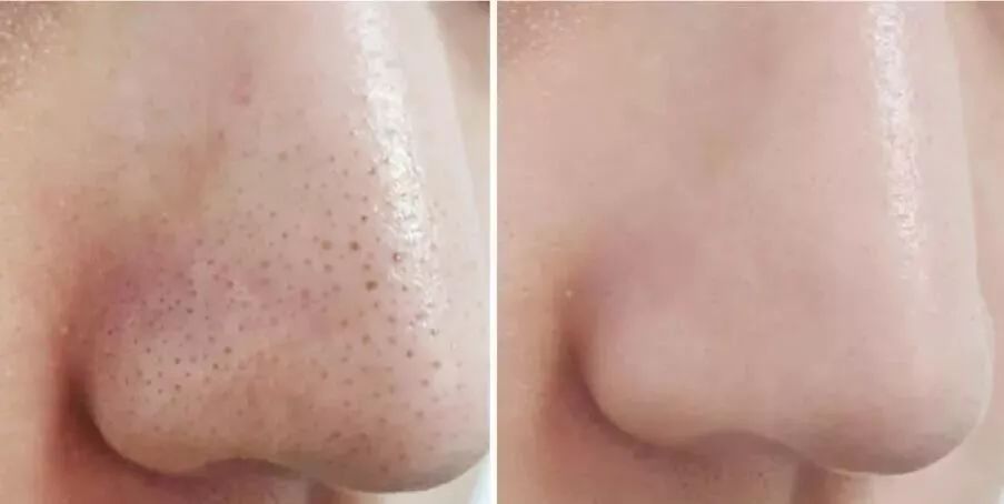 去黑头鼻贴推荐黑头导出液,去黑头的最好办法告别草莓鼻