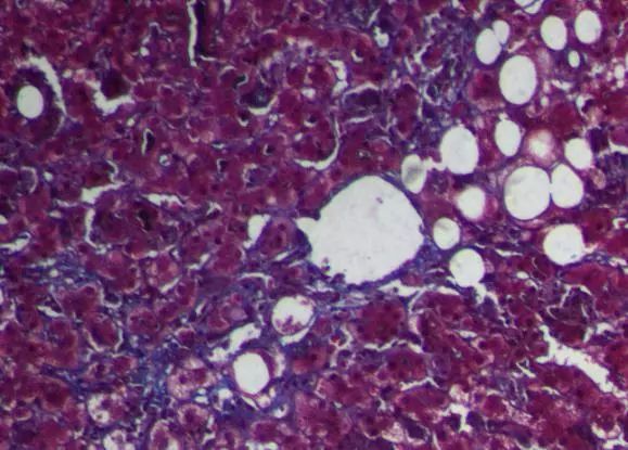 胆汁淤积是左侧还是右侧,胆汁淤积是胆有病还是肝有病