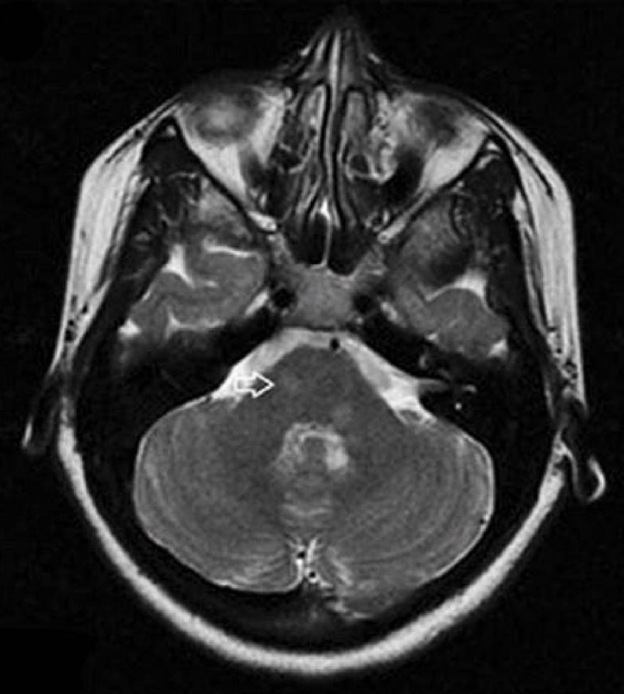 矛盾反应、Carney综合征、脑梗死、笑气中毒丨3分钟读片·第19期