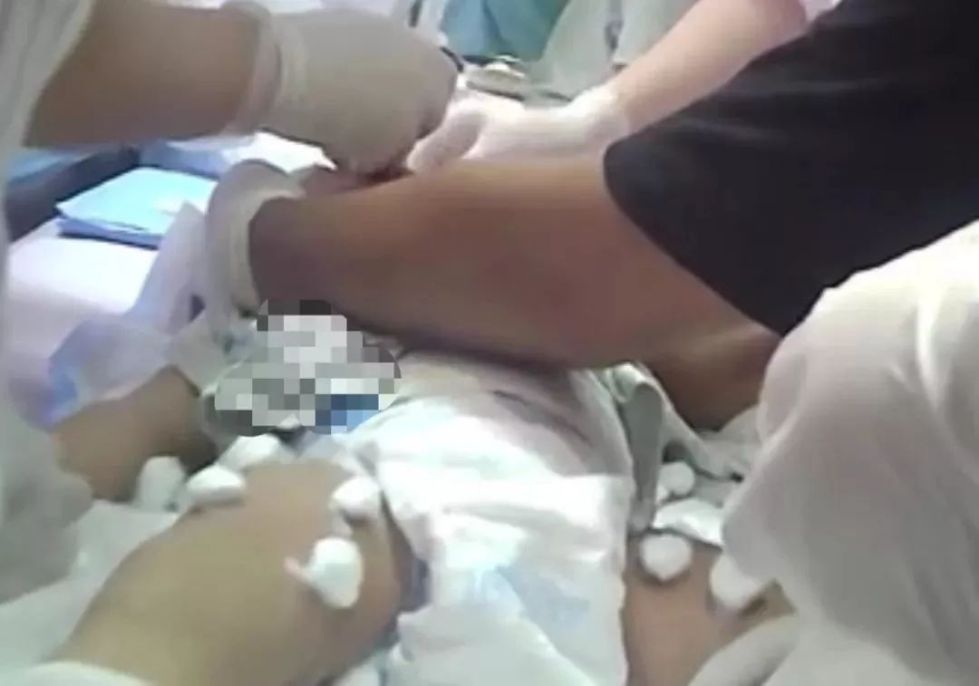 封针治疗脑瘫是什么意思,郑大三附院脑瘫科封针副作用