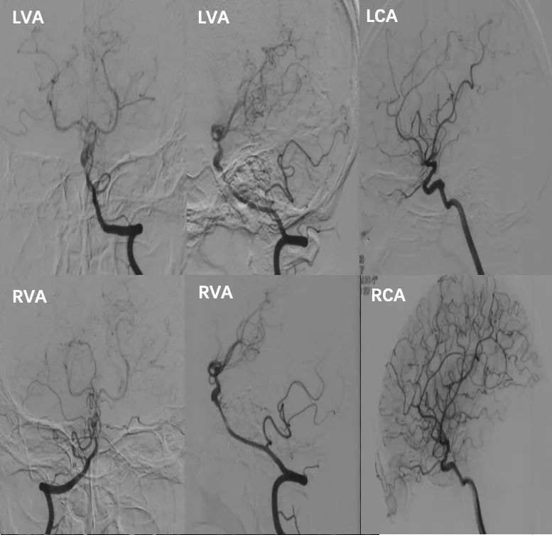 穆如清风·第13期｜Tubridge治疗基底动脉巨大夹层动脉瘤