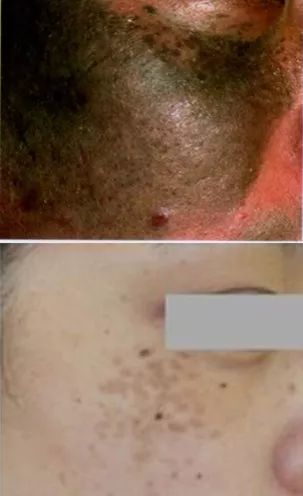 祛斑最有效是仪器还是产品,公认的祛斑第一名食物